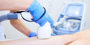 Epilare definitivă laser